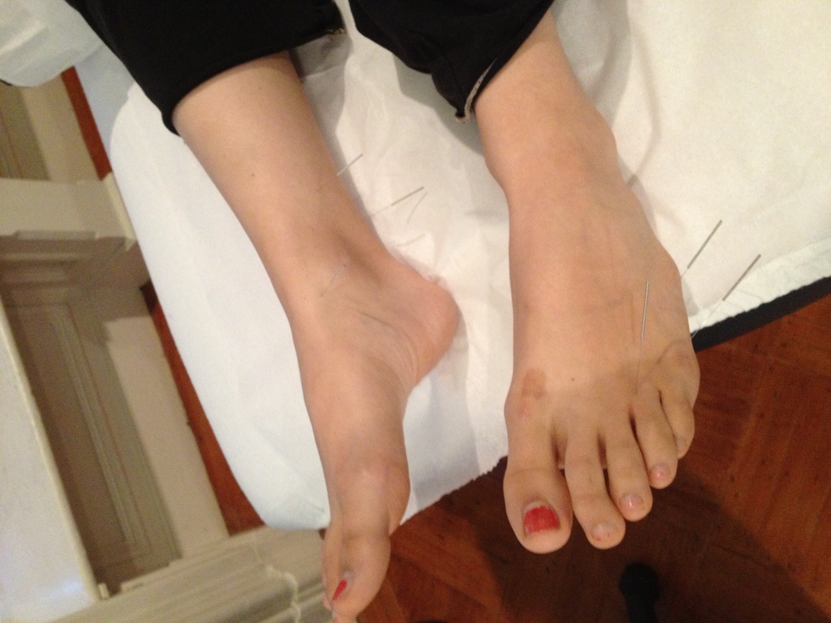 feet acupuncture